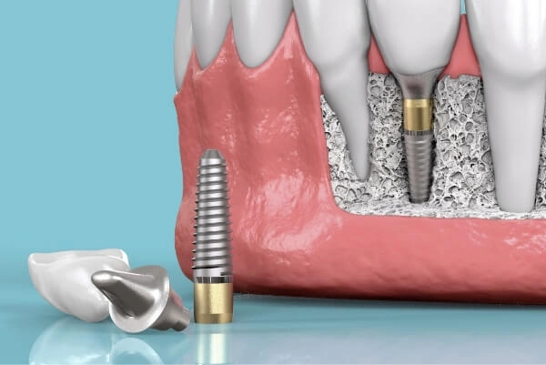 人工植牙