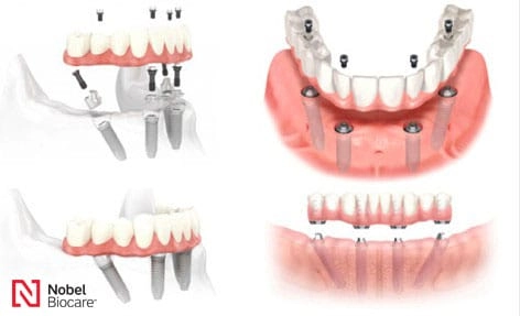 All-on-4 全口速定 治療方案