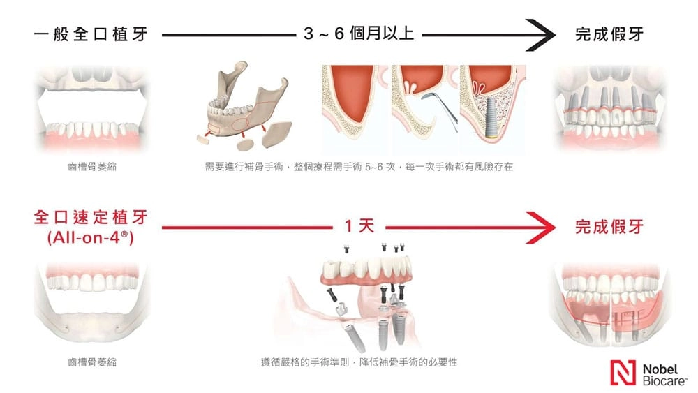 All-on-4 全口速定 治療方案