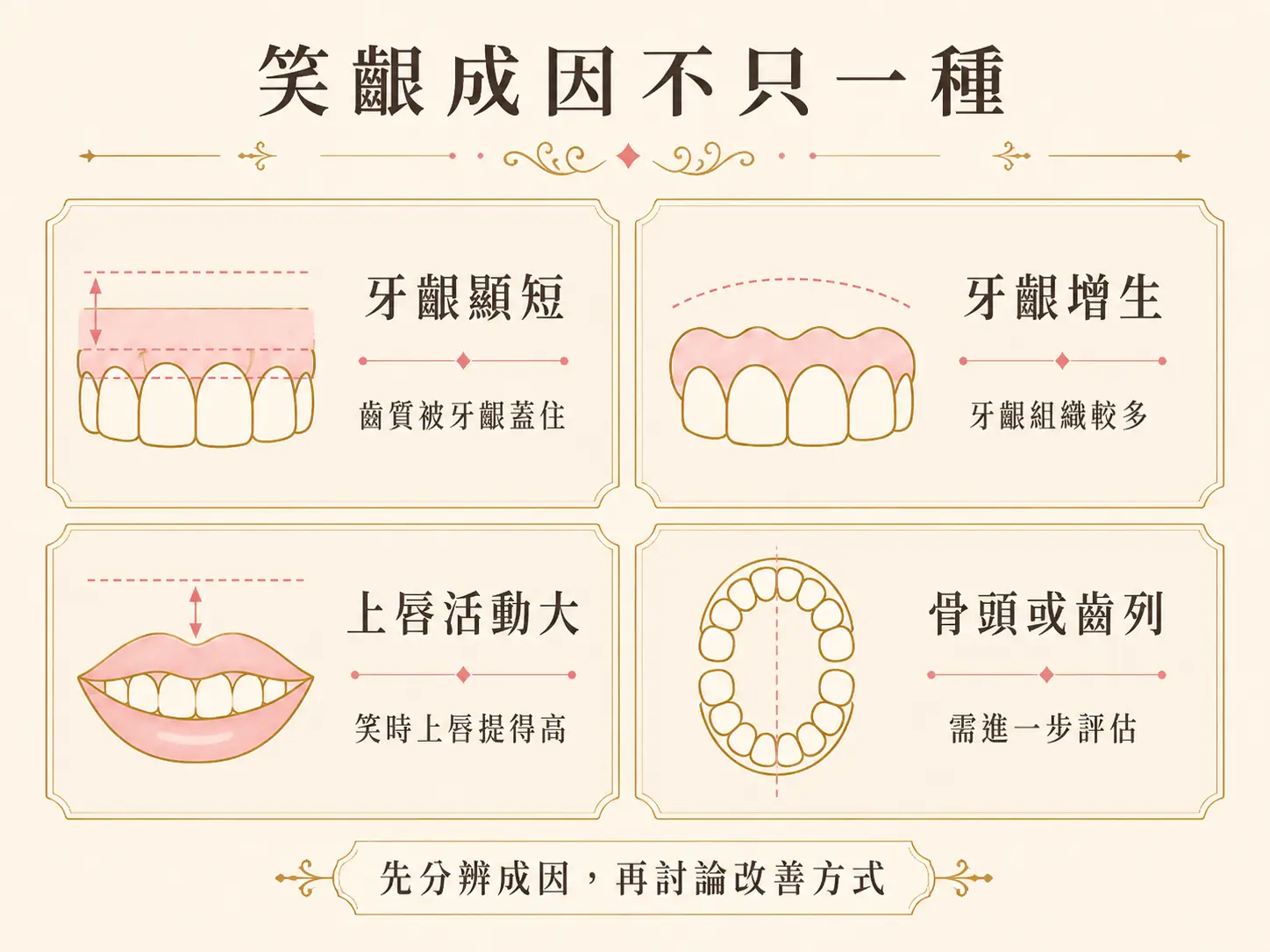 笑齦常見成因比較圖，整理牙齦覆蓋、牙齒比例、上唇活動與骨骼因素